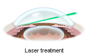 Laser Treatment of Glaucoma Doylestown