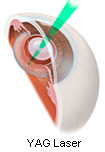 YAG Laser Capsulotomy Doylestown