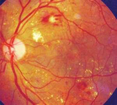 Diabetic Retinopathy Treatment Doylestown