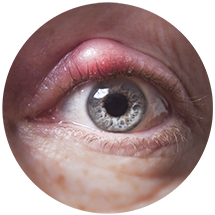Dry Eye Treatment | Blepharitis Treatment Doylestown PA