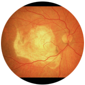 Macular Degeneration Treatment | Diabetic Retinopathy Treatment Doylestown PA