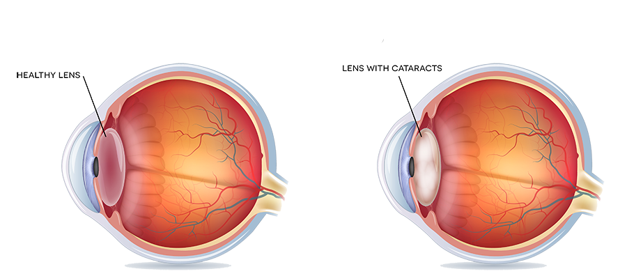 Cataract