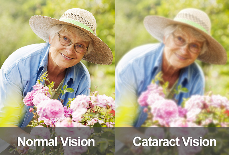 Cataract