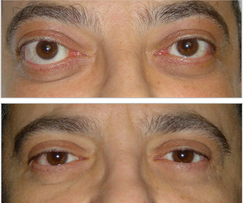 Orbital Decompression Treatment Doylestown PA