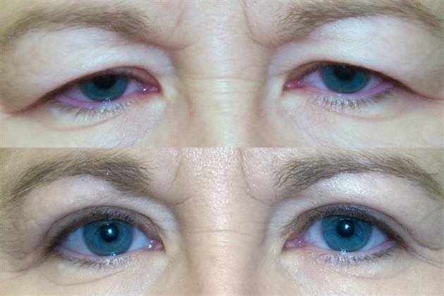 Blepharoplasty and Ptosis Treatment Doylestown PA