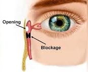 Dacryocystorhinostomy Treatment Doylestown PA