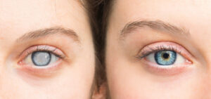 Refractive Cataract Surgery Doylestown PA