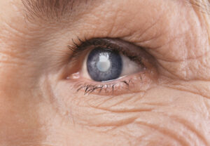 Close up of a senior woman's eye, showing a cataract, before her laser cataract surgery