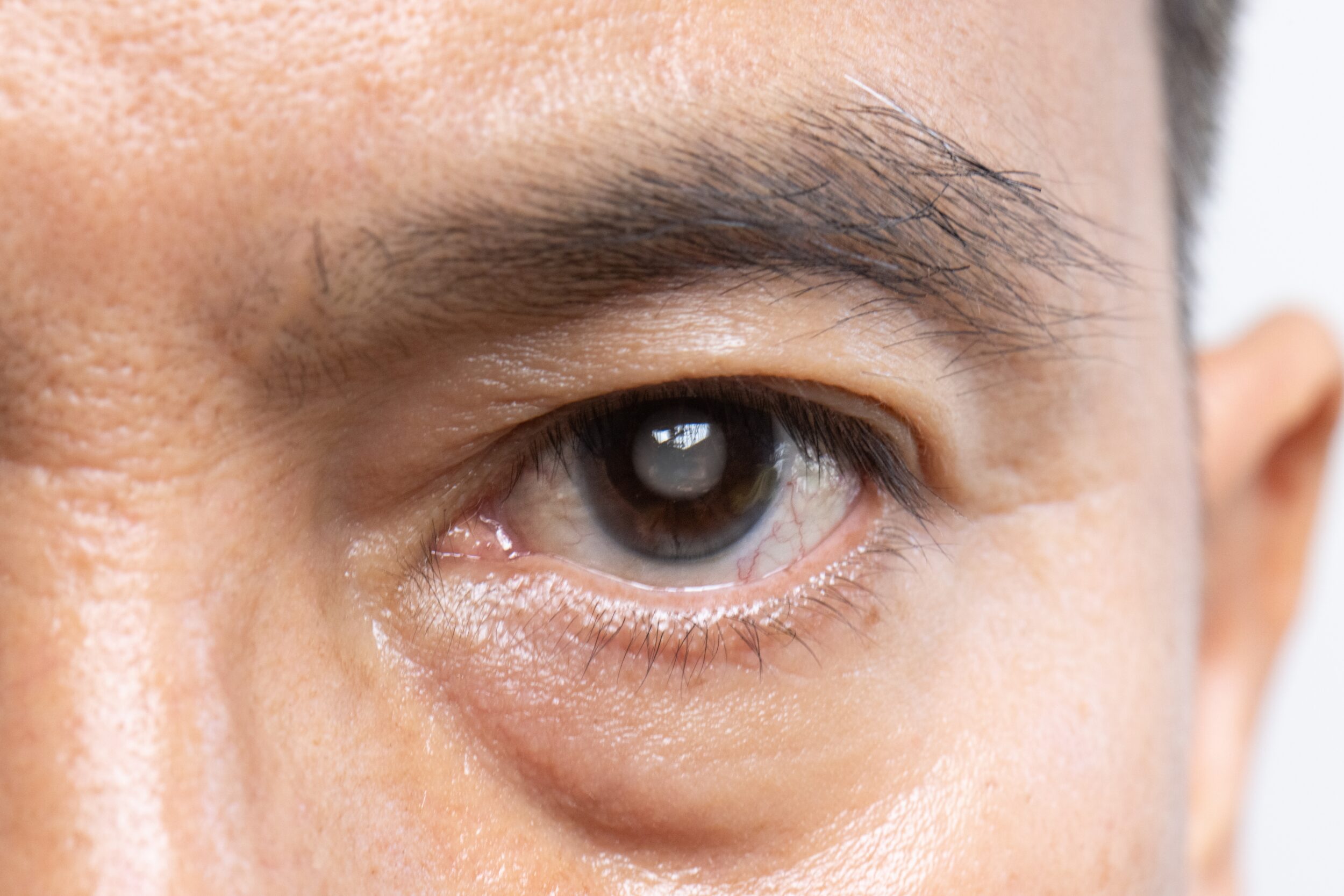 Man with a cataract looks straight ahead, showing a cloudiness in the eye